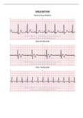 Prophecy EKG Strips|Relias Dysrhythmia Basic Test A